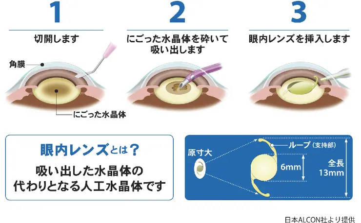 【裁断済み】有水晶体眼内レンズ手術 裁断済み】有水晶体眼内レンズ手術Ω