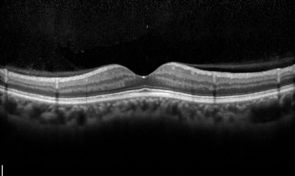retinal-2.jpg.webp
